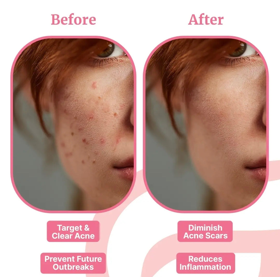 GlowUp' Acne Wand